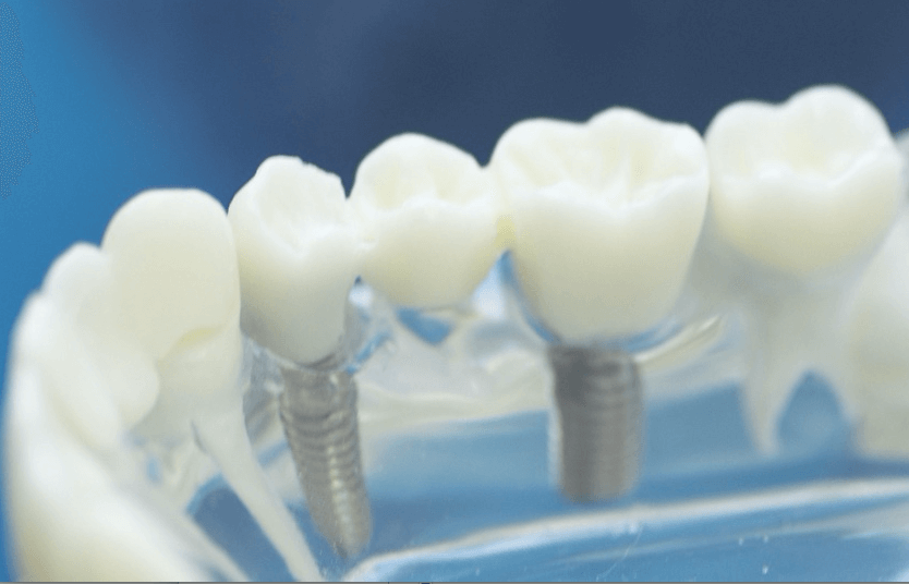 Image for Dental Implants vs Dentures – Pros & Cons  on Morgan Street Dental Centre - Dental Implants in Clear Gum Model