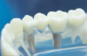 Dental Implants vs Dentures – Pros & Cons