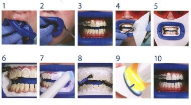 Teeth Whitening Options Blog on Morgan Street Dental Centre - Stages of Dental Teeth Whitening in Steps 