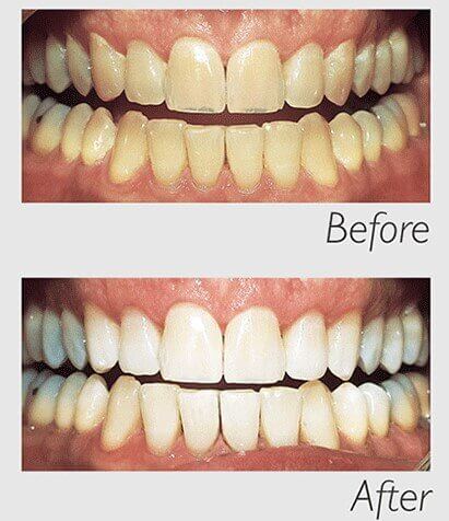 How Does In-Chair Teeth Whitening Work Blog on Morgan Street Dental Centre - Before and After Dental Zoom Dental Whitening