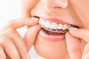 Invisible Dental Braces – Why Clear Aligners?