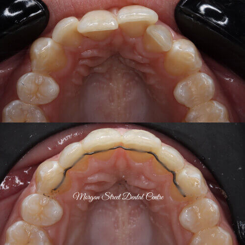 Invisible Dental Braces Why Clear Aligners on Morgan Street Dental Centre - Teeth Compared Before and After Clear Aligners Image