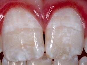 What are white spots on teeth and what can you do about them