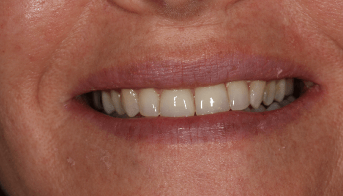 Morgan Street Dental Centre Smile Gallery - Before and After Images Composite Veneer After Add_White2Before-copy-4
