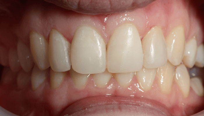 Morgan Street Dental Centre Smile Gallery - Before and After Images Composite Veneer After Add_White2Before-copy-6
