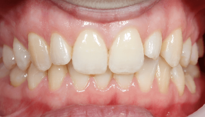 Morgan Street Dental Centre Smile Gallery - Before and After Images Composite Veneer After Add_White2Before-copy-6