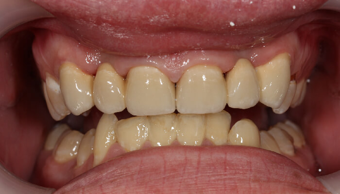 Morgan Street Dental Centre Smile Gallery - Before and After Images Dental Bridges After MSDC_Brideg1After