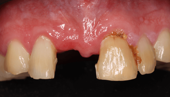 Morgan Street Dental Centre Smile Gallery - Before and After Images Dental Bridges After Add_White2Before-copy-2