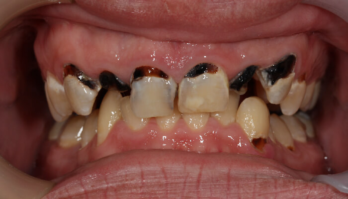 Morgan Street Dental Centre Smile Gallery - Before and After Images Dental Bridges After MSDC_Brideg1After