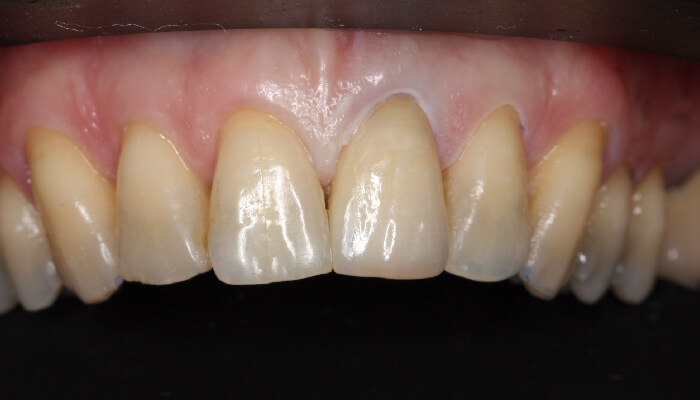 Morgan Street Dental Centre Smile Gallery - Before and After Images Dental Crowns MSDC_Crown1After