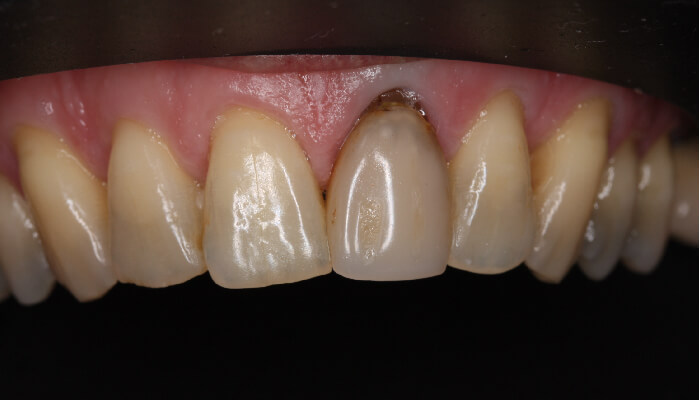 Morgan Street Dental Centre Smile Gallery - Before and After Images Dental Crowns MSDC_Crown1After