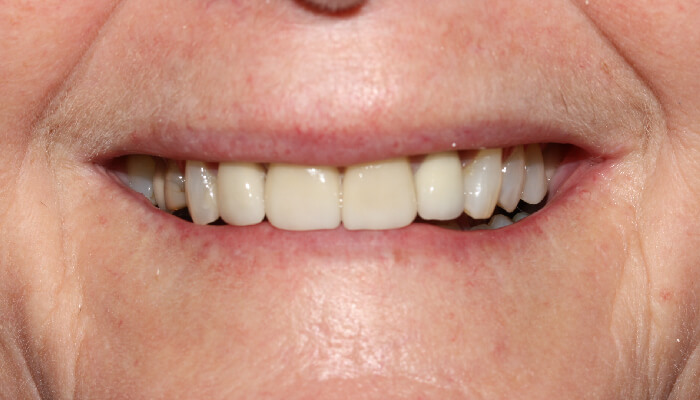 Morgan Street Dental Centre Smile Gallery - Before and After Images Dental Crowns MSDC_Crown2After