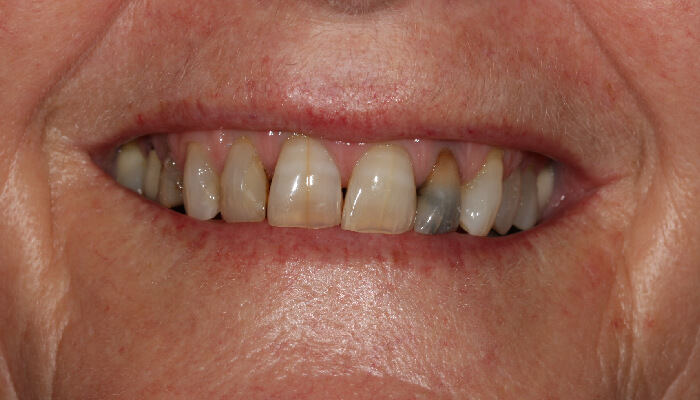 Morgan Street Dental Centre Smile Gallery - Before and After Images Dental Crowns MSDC_Crown2After