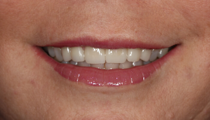 Morgan Street Dental Centre Smile Gallery - Before and After Images Dental Crowns MSDC_Crown3After