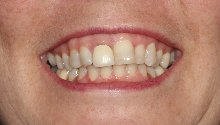 Morgan Street Dental Centre Smile Gallery - Before and After Images Dental Crowns MSDC_Crown3After