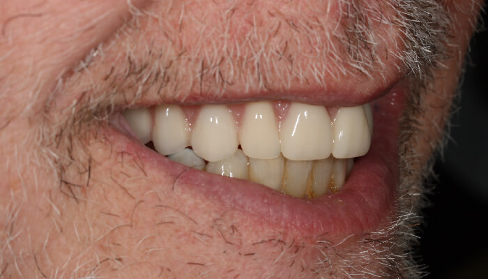 Morgan Street Dental Centre Smile Gallery - Before and After Images Dental Implant After MSDC_Implant1After