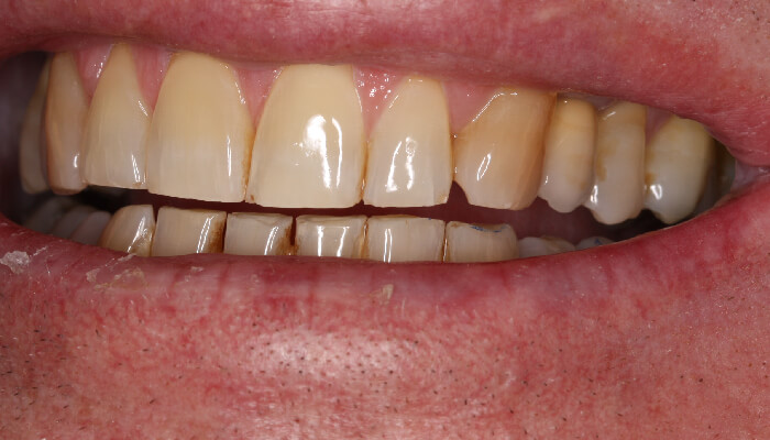 Morgan Street Dental Centre Smile Gallery - Before and After Images Dental Implant After MSDC_Implant2After