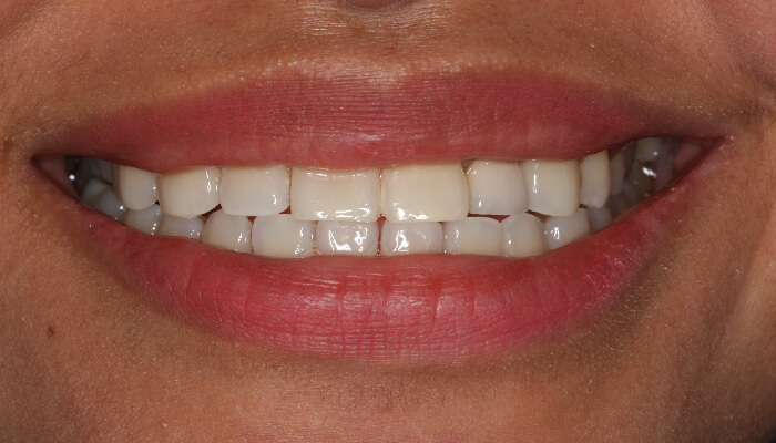 Morgan Street Dental Centre Smile Gallery - Before and After Images Dental Implant After MSDC_Implant3After