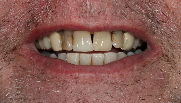 Morgan Street Dental Centre Smile Gallery - Before and After Images Dental Implant After MSDC_Implant1After