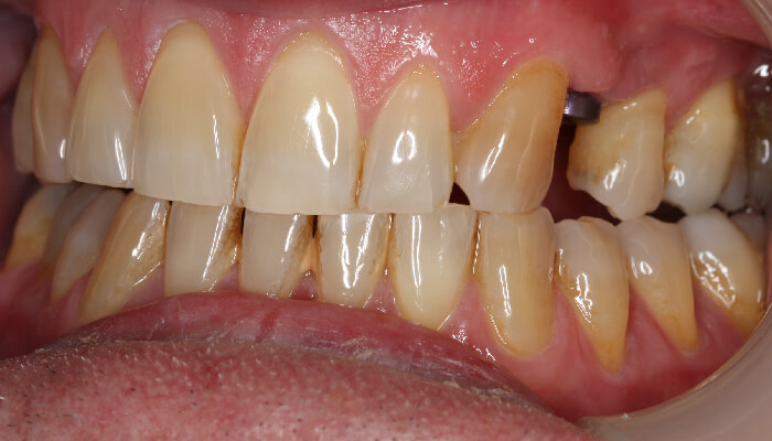 Morgan Street Dental Centre Smile Gallery - Before and After Images Dental Implant After MSDC_Implant2After