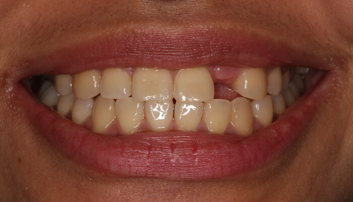 Morgan Street Dental Centre Smile Gallery - Before and After Images Dental Implant After MSDC_Implant3After