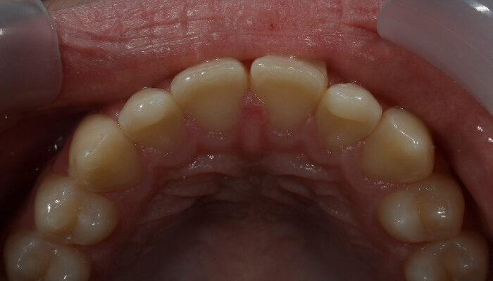 Morgan Street Dental Centre Smile Gallery - Before and After Images Orthodontics After MSDC_Ortho1After-20