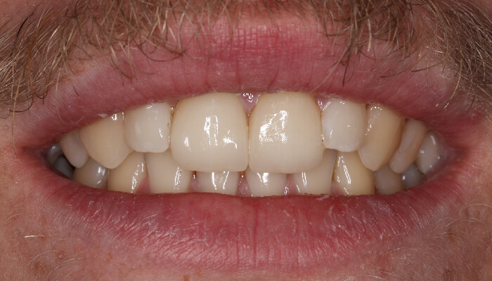 Morgan Street Dental Centre Smile Gallery - Before and After Images Porcelain Veneers After MSDC_Veneers1After