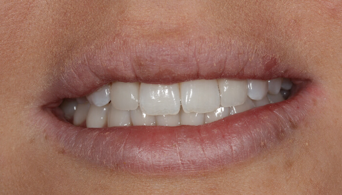 Morgan Street Dental Centre Smile Gallery - Before and After Images Porcelain Veneers After MSDC_Veneers2After