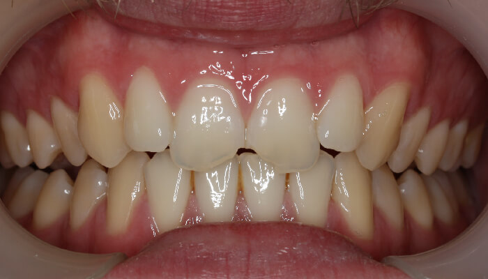 Morgan Street Dental Centre Smile Gallery - Before and After Images Porcelain Veneers After MSDC_Veneers1After