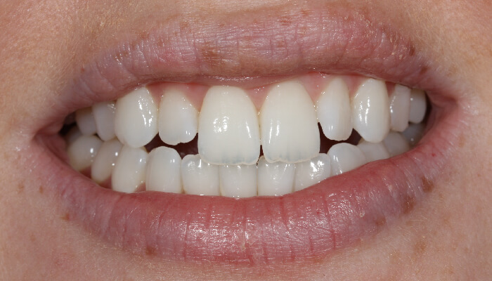 Morgan Street Dental Centre Smile Gallery - Before and After Images Porcelain Veneers After MSDC_Veneers2After