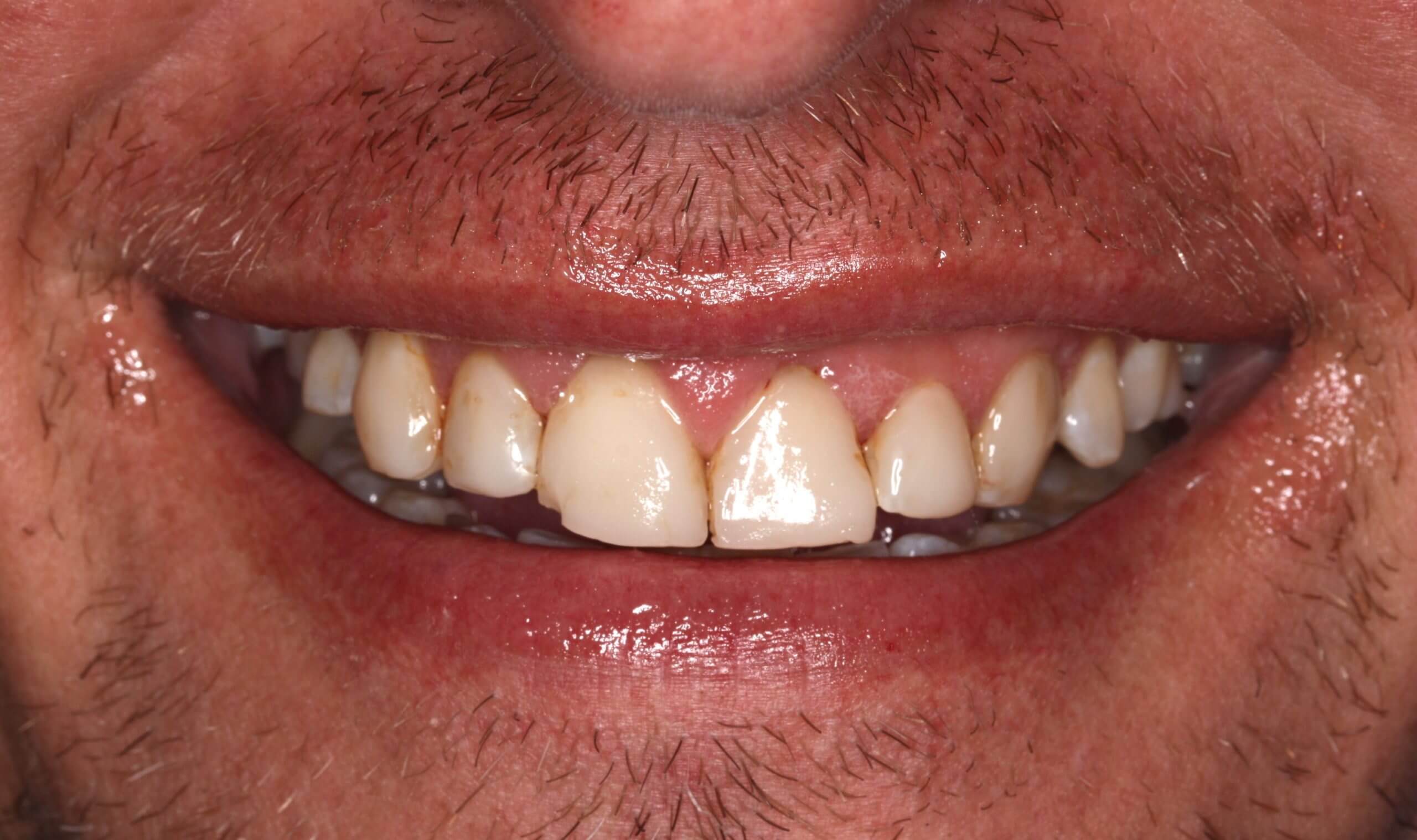 Morgan Street Dental Centre Smile Gallery - Before and After Images Smile Design Nathan Before Edited