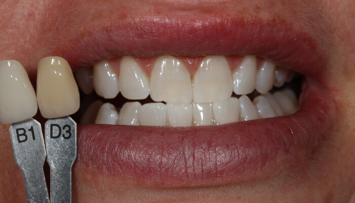 Morgan Street Dental Centre Smile Gallery - Before and After Images Teeth Whitening After MSDC_White1After