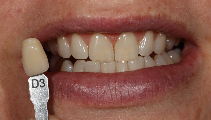 Morgan Street Dental Centre Smile Gallery - Before and After Images Teeth Whitening After MSDC_White1After