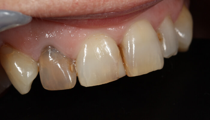 Morgan Street Dental Centre Smile Gallery - Before and After Images Teeth Whitening Before MSDC_Whte2After