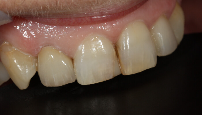 Morgan Street Dental Centre Smile Gallery - Before and After Images Teeth Whitening Before MSDC_Whte2After