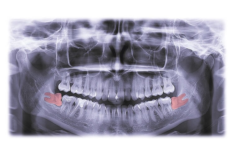 Morgan Street Dental Centre Wisdom Teeth Extraction - Dental X-ray with Molar Teeth wisdom-teeth