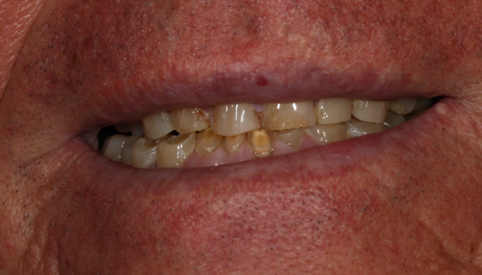 Morgan Street Dental Centre Smile Gallery - Before and After Images Dental Bridges After MSDC_Brideg1After