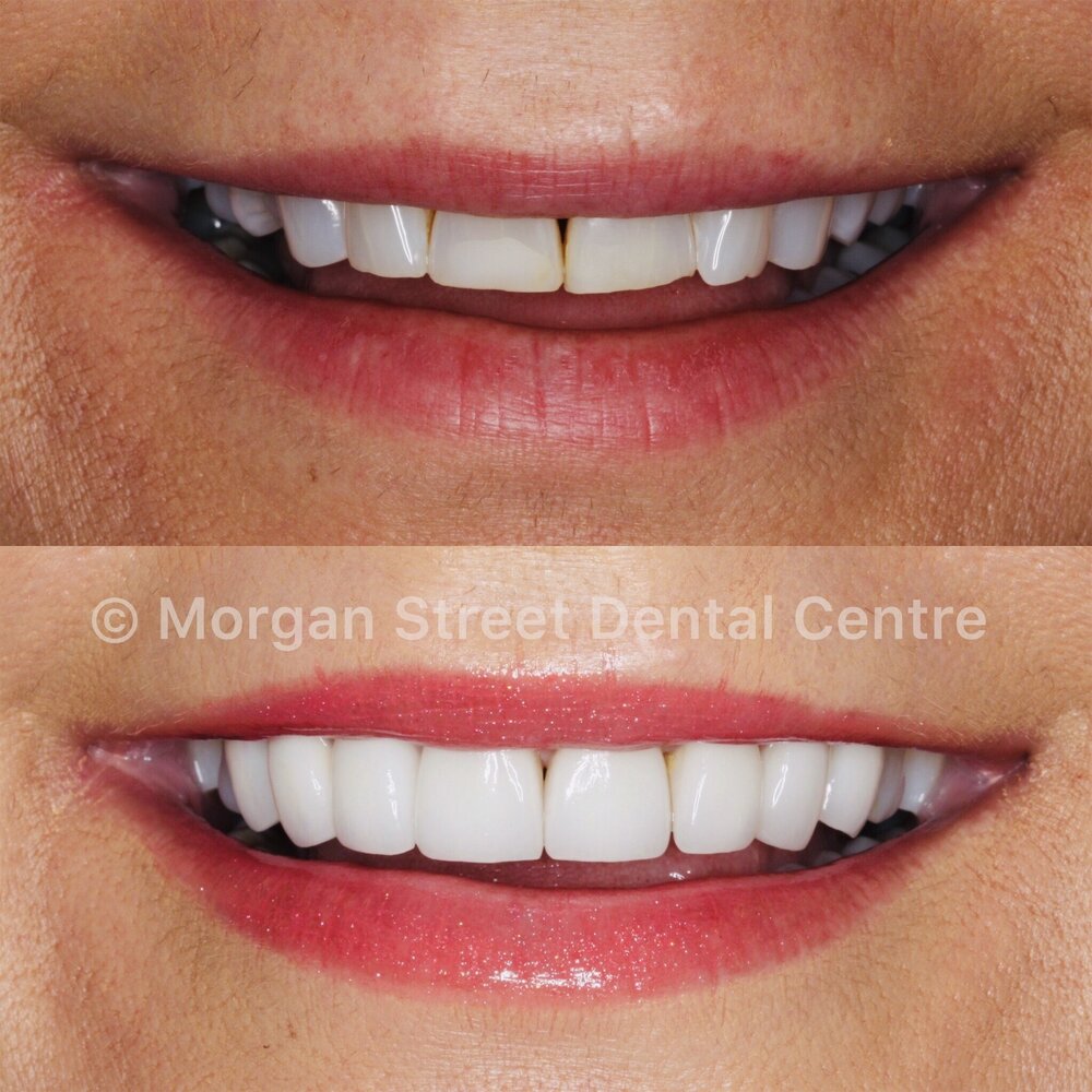 dentist+wagga+porcelain+veneers
