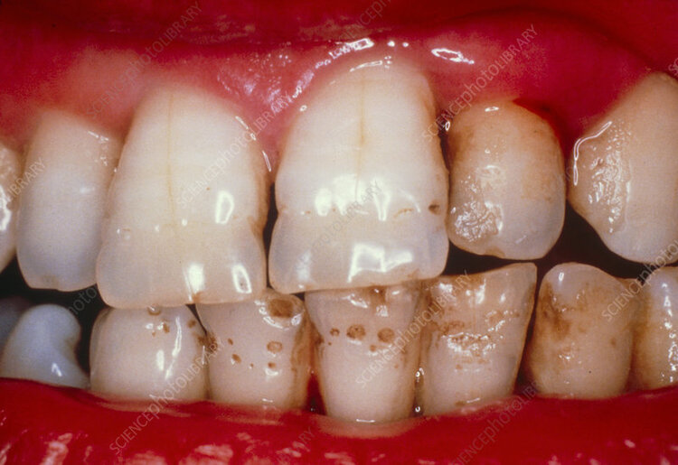 Pitted teeth: hypoplasia of the enamel