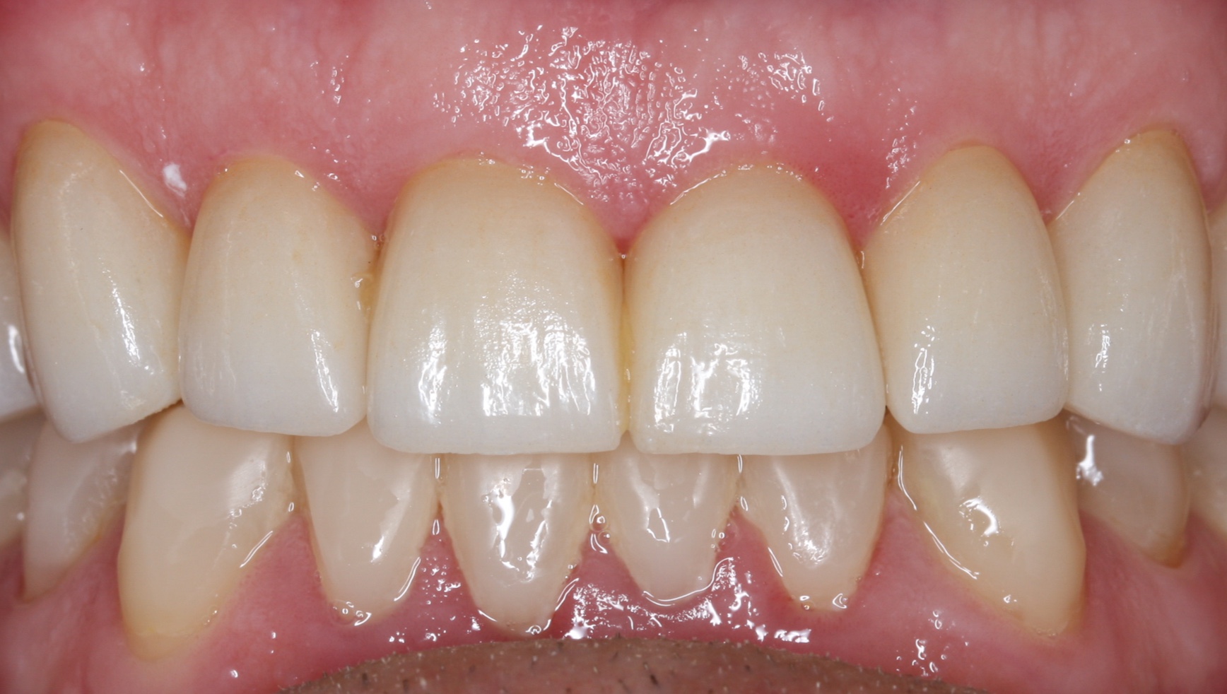 Morgan Street Dental Centre Smile Gallery - Before and After Images Dental Bridges After MSDC_Brideg1After