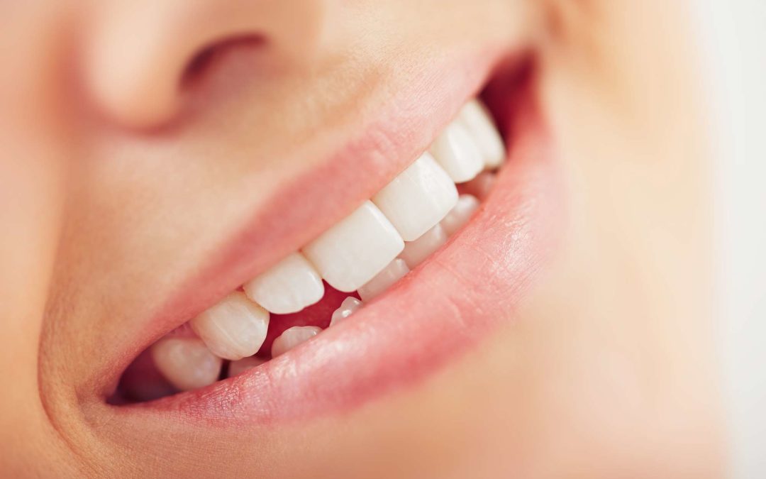 Composite vs. Porcelain Dental Veneers – Which is Better?