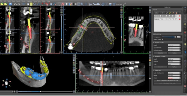 Morgan Street Dental Centre Dental Implants Image - Computer Guided Implant Surgery