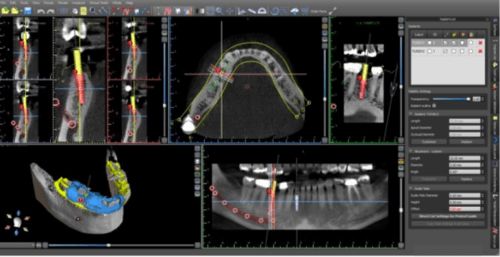 Morgan Street Dental Centre Dental Implants Image - Dental Computer Guided Implant Surgery Illustration