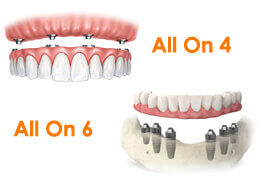 Morgan Street Dental Centre Dental Implants Image - Full Dental Implant Illustration Image