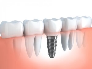 Morgan Street Dental Centre Dental Implants Image - Single Tooth Implant Image Illustration 