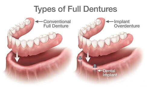 Morgan Street Dental Centre Dental Implants Image - Type of Full Dentures Image Illustration 