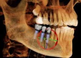 Morgan Street Dental Centre Dental Practice Technology - Cone Beam CT and Computer Guided Implants