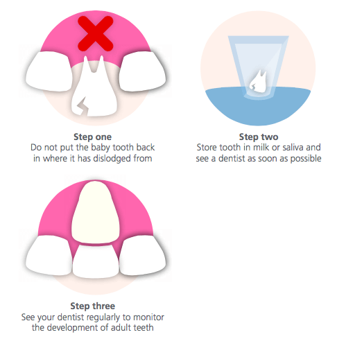 Morgan Street Dental Centre Emergency Dentistry Wagga -Knocked Out Baby Tooth Illustration