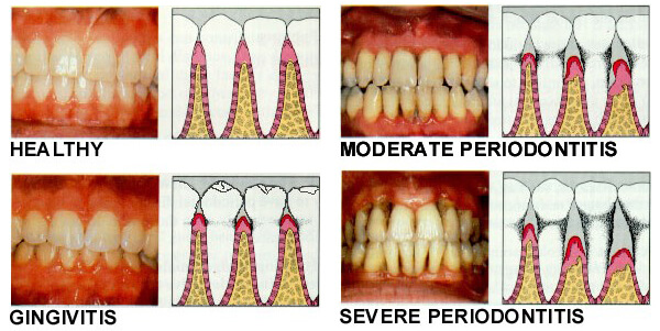 receding gums stages