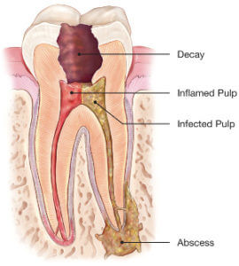 Morgan Street Dental Centre Root Canal Therapy - Decayed Tooth with Abscess Illustration Image